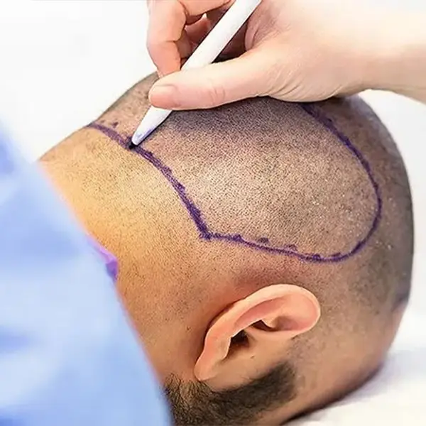 Hair Transplant: The Key to a Natural Look and a Confident You